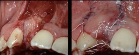 Soft tissue management during primary bone augmentation